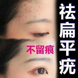 扁平疣面部去除丝状疣治疗祛疣瘊子寻常疣跖疣专用药膏一抹灵正品