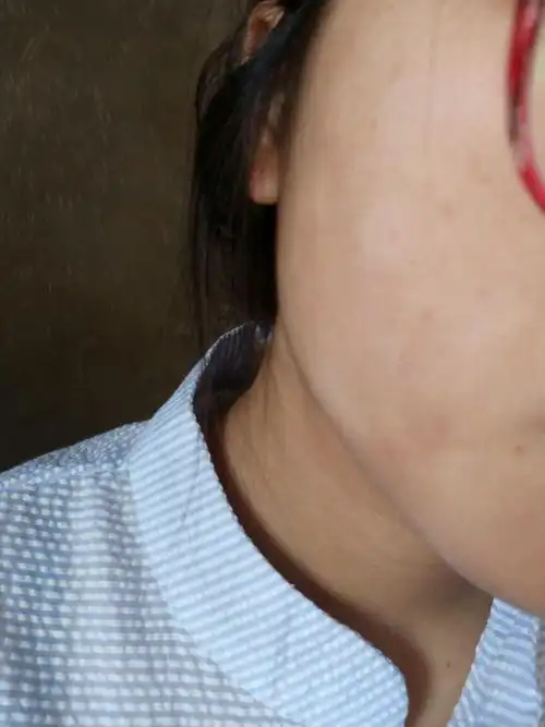 脸上有白色的小斑是怎么回事