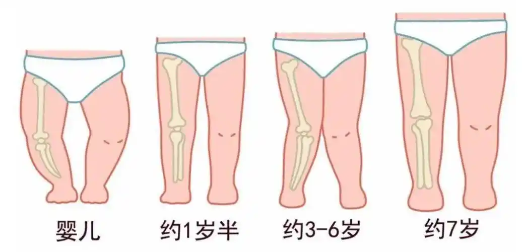 大约到2岁左右,宝宝腿会变直,接着因为生长发育原因,腿部会呈"x"状,这