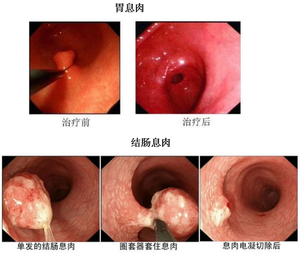 胃肠道息肉会癌变吗