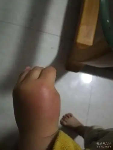 吓人红火蚁倾巢而出被一只流窜的蚂蚁咬了一口手肿得像个包子