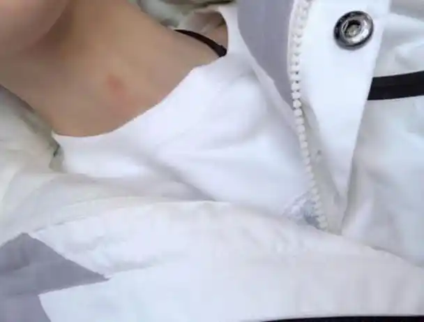 颈子上的草莓怎么快速消除,请问脖子种的草莓如何快速消除?