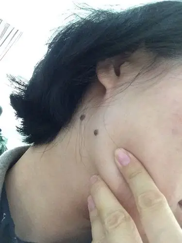 凸起的痣还是切了好.