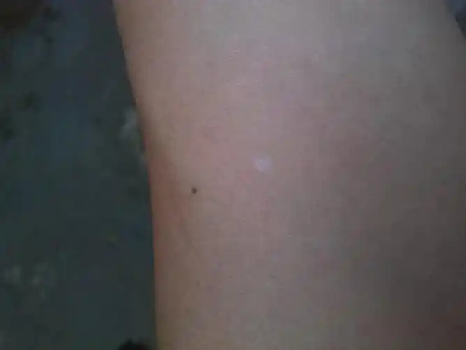 前些日子发现左手小臂上起了个白点,直径2mm,还不知道会不会
