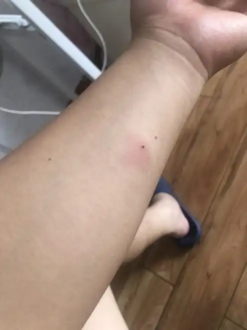 ppd做了第二天就红了一片,好害怕