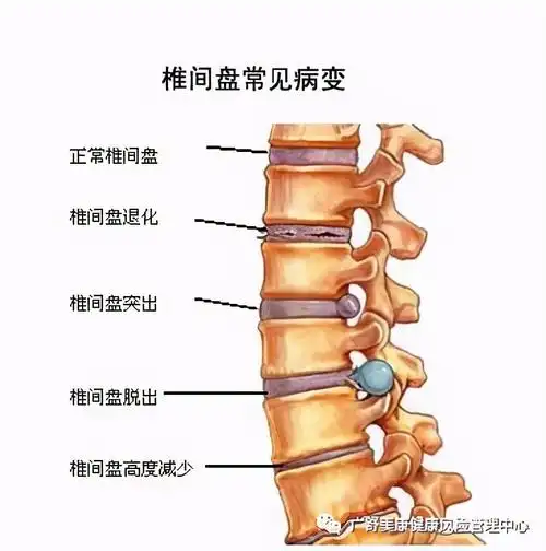 中医支招调理腰椎间盘突出中药外治法的优势