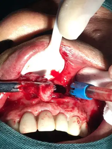 高陵区医院口腔科成功开展上颌骨囊肿切除(牙源性) 倒充填术一例