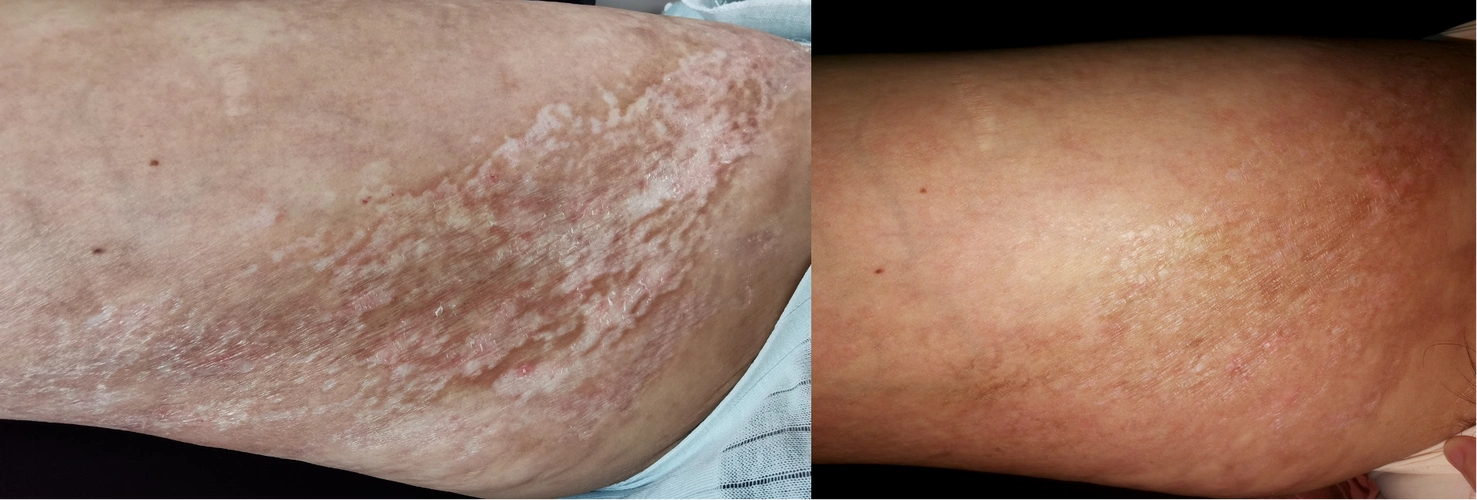 线状硬皮病治疗经验分享_硬皮病_症状表现_治疗方式 - 好大夫在线