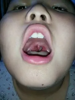 残忍拒绝 推荐回答              你好,扁桃体大除非是发炎引起,不然