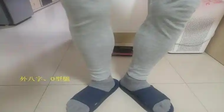 八字扁平足o型腿下交叉综合征等一系列问题出现的概率大幅下降外八字