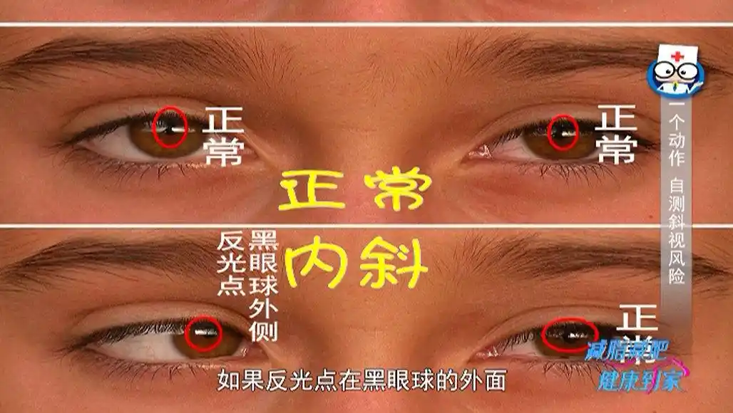 家长可以自测孩子是否斜视?专家:一个手电筒就能筛查