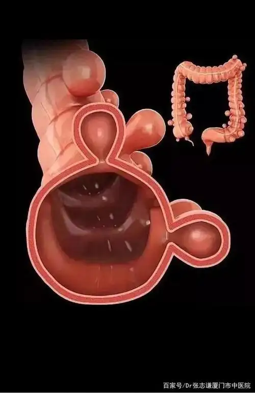 大量便血原来是结肠憩室在作祟