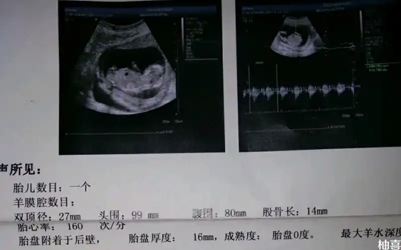 nt超声图像的单子上有圈圈是不是怀男孩的标志