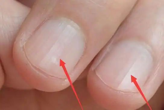 指甲上突然发现竖纹要提防了,多吃这些食材可改善,让身体更健康