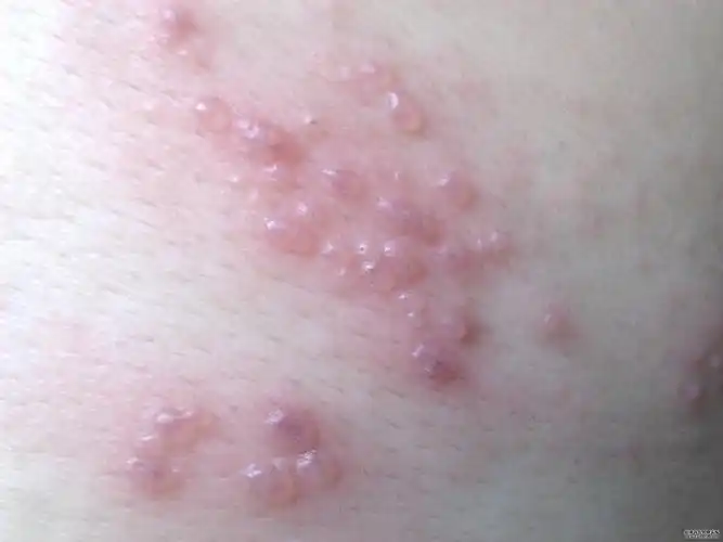 p>水痘-带状疱疹病毒(varicella-zoster virus,vzv)是指在儿童初次