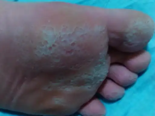 脚底板皮有一个个小洞呈蜂窝状,不痛不痒