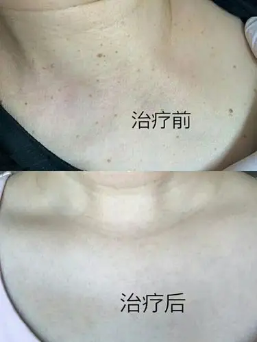 露脖季,别让丝状疣毁了你的玉颈