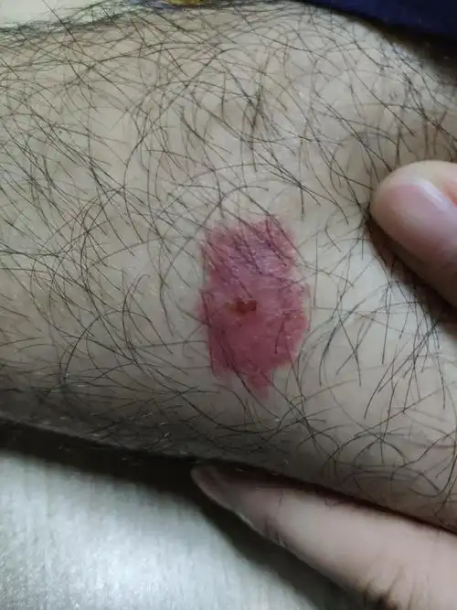 这种伤口是什么虫子咬的