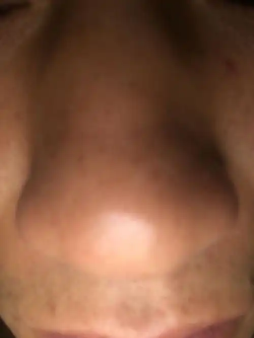 鼻头大都有一条横杠出现,怎么能瘦下去求高手指教!