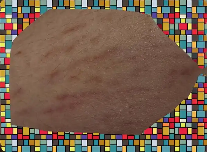 求助!请问大腿上这种发红的纹路,是肥胖纹吗(破案了 是生长纹