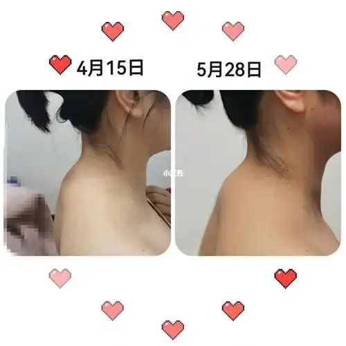 翼状肩胛骨  太痛苦了,#斜方肌  #富贵包  #圆