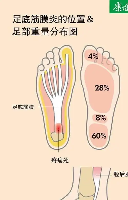 6种人容易发生足底筋膜炎你是其中一种吗