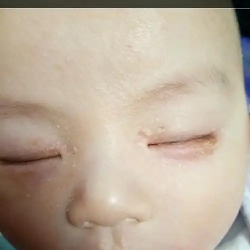 宝宝湿疹眼角周围脱皮反反复复