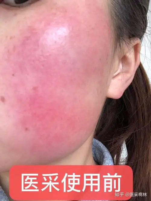 冬天里的敏感肌肤有多难受