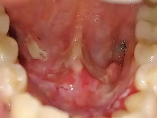 咽部肿瘤图片_咽部肿瘤症状表现图片大全_有来医生