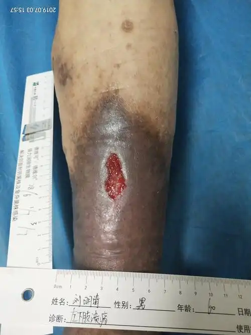 慢性伤口之静脉性溃疡愈合过程展示