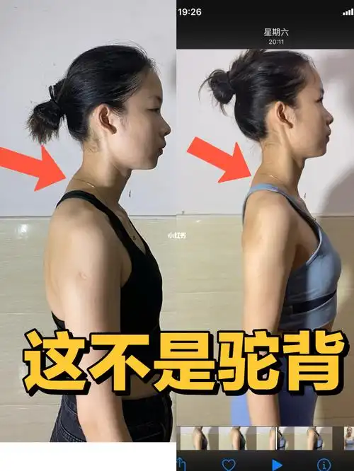 侧面看圆肩"驼背"打开肩膀挺直背,还是脖子前倾摸起来有骨头凸起的