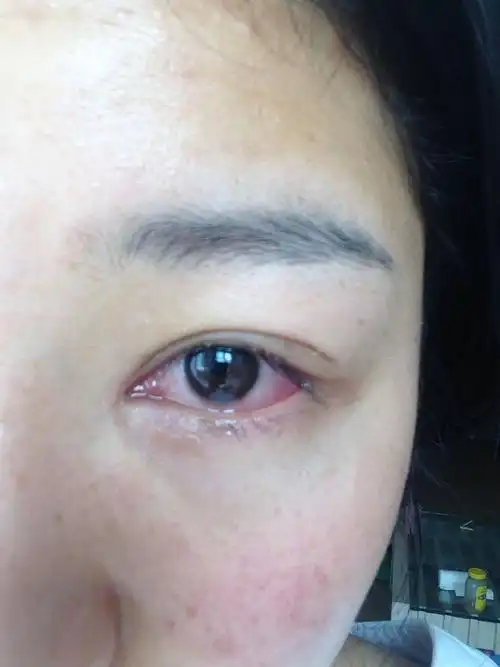 眼睛特别红,医院检查说是急性结膜炎,可是开了眼药水用了两天都不见好