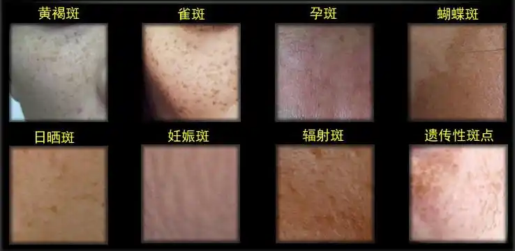 哈尔滨大美整形激光祛斑