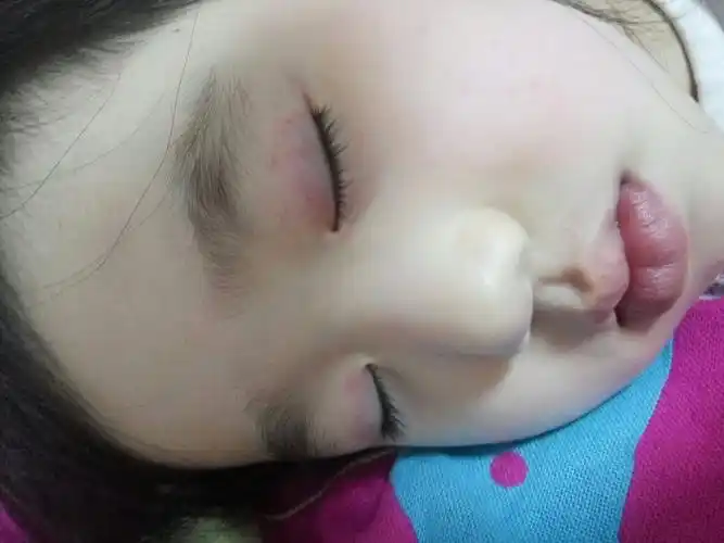 宝宝五岁第一次哭过后眼皮上出现很多出血点出血点下