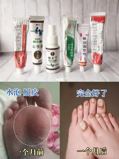 多年的脚气终于遇到了脚气的克星