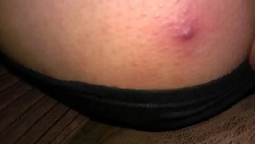 相邻近的多个毛囊感染,炎症融合形成的叫痈