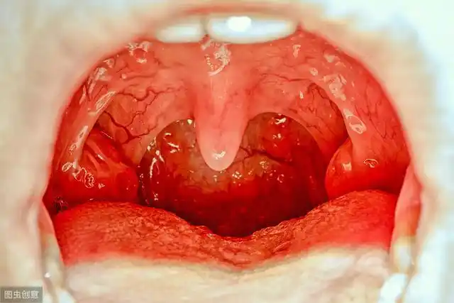 当心慢性咽炎饮水咽吐沫也可能会引起喉痉挛