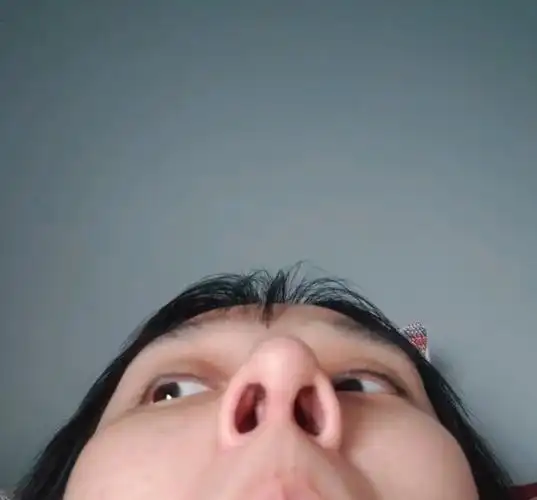 隆鼻两个月鼻中隔弯曲有点影响嗅觉和呼吸