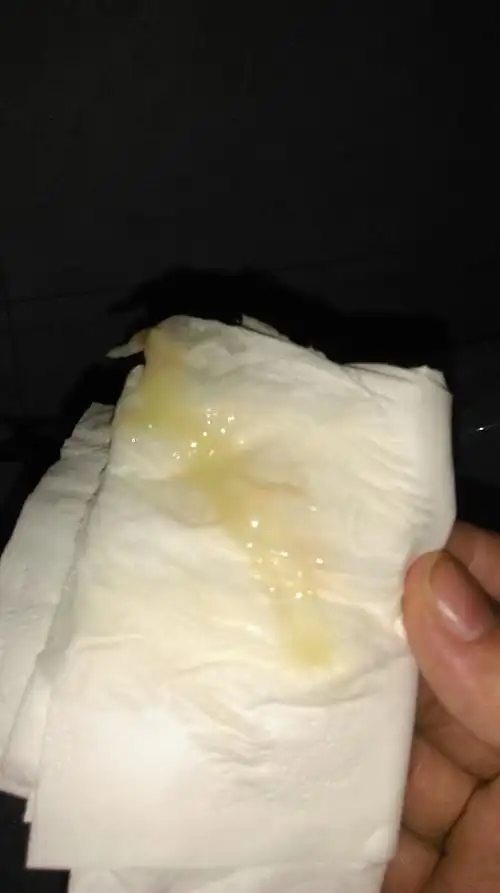 这是白带还是宫颈黏液,是不是带有血丝