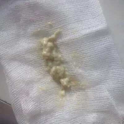 我在网上看到跟我一样情况的图片,我去医院检查白带正常,有没有跟我一