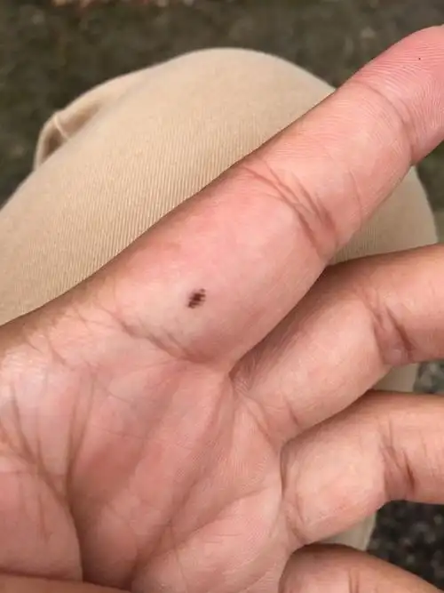 手指上有个痣?是不是皮肤癌?