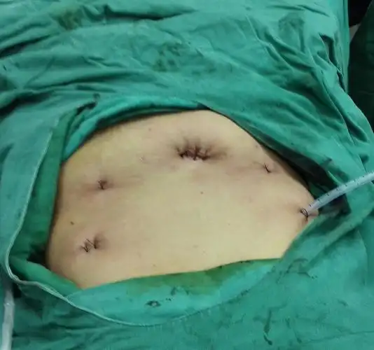 全腹腔镜下消化道重建是腹腔镜下胃癌手术的难点之一.