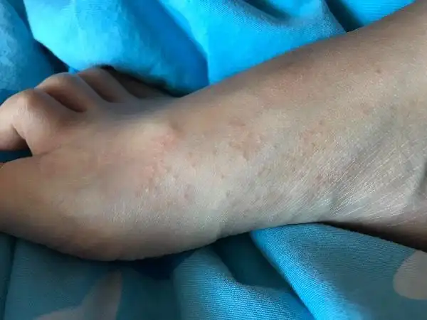 脚面上突然长了很多小疙瘩.请大家给我看看这是什么?谢谢了!