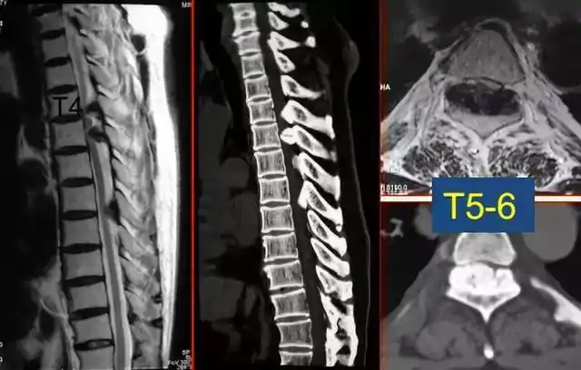 本病常用的术式为胸椎后路全椎板切除减压术,可直接解除椎管后壁的