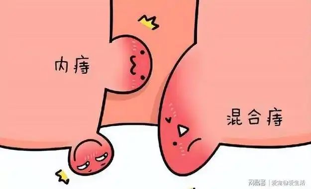 医生:经常清洗可能预防4种病|痔疮|提肛运动_网易订阅