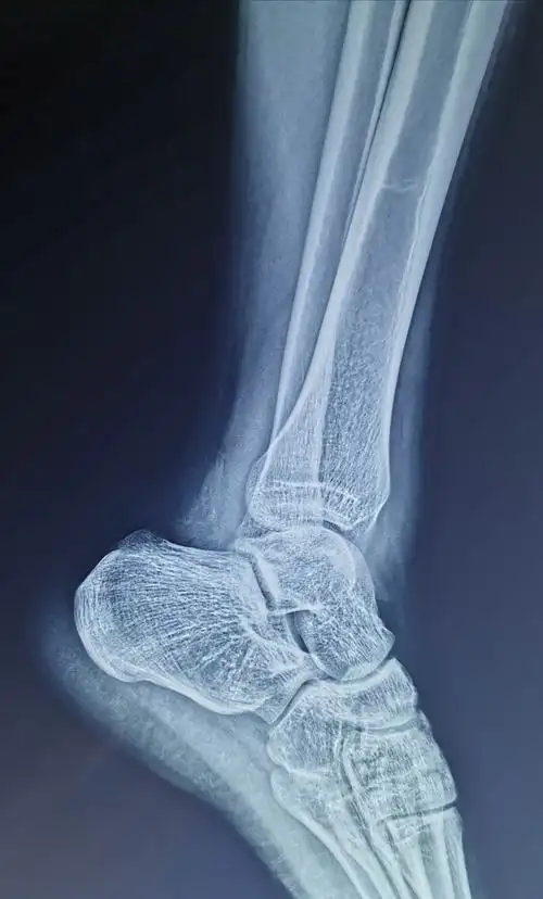 一例腓骨下极撕脱骨折