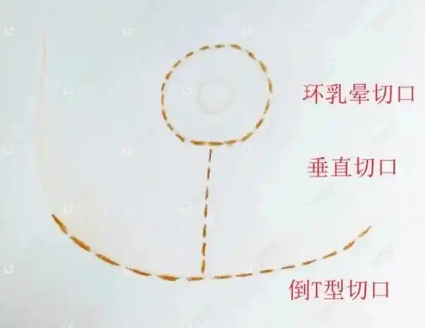 从乳房下垂矫正术恢复图来看双环法比棒棒糖悬吊的切口疤痕要小