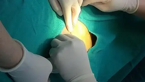 玻尿酸治疗男性早泄的过程