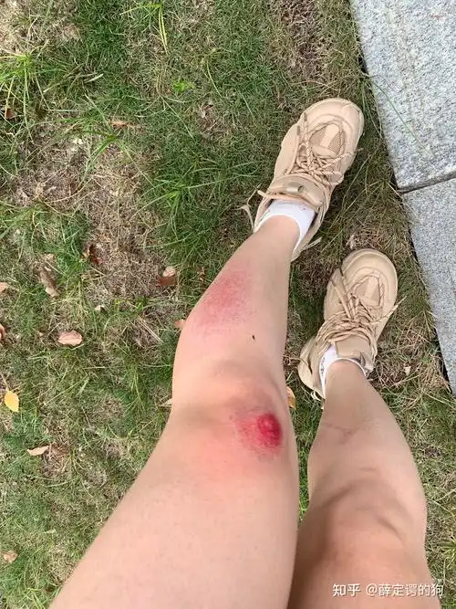 骑车摔倒后擦伤,伤口的湿性愈合