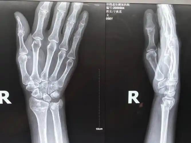 尺骨是哪个部位图片